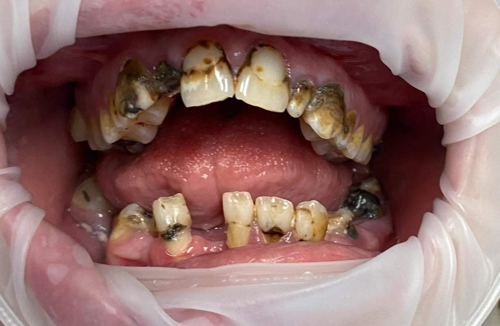 Patient smile before full arch implant treatment