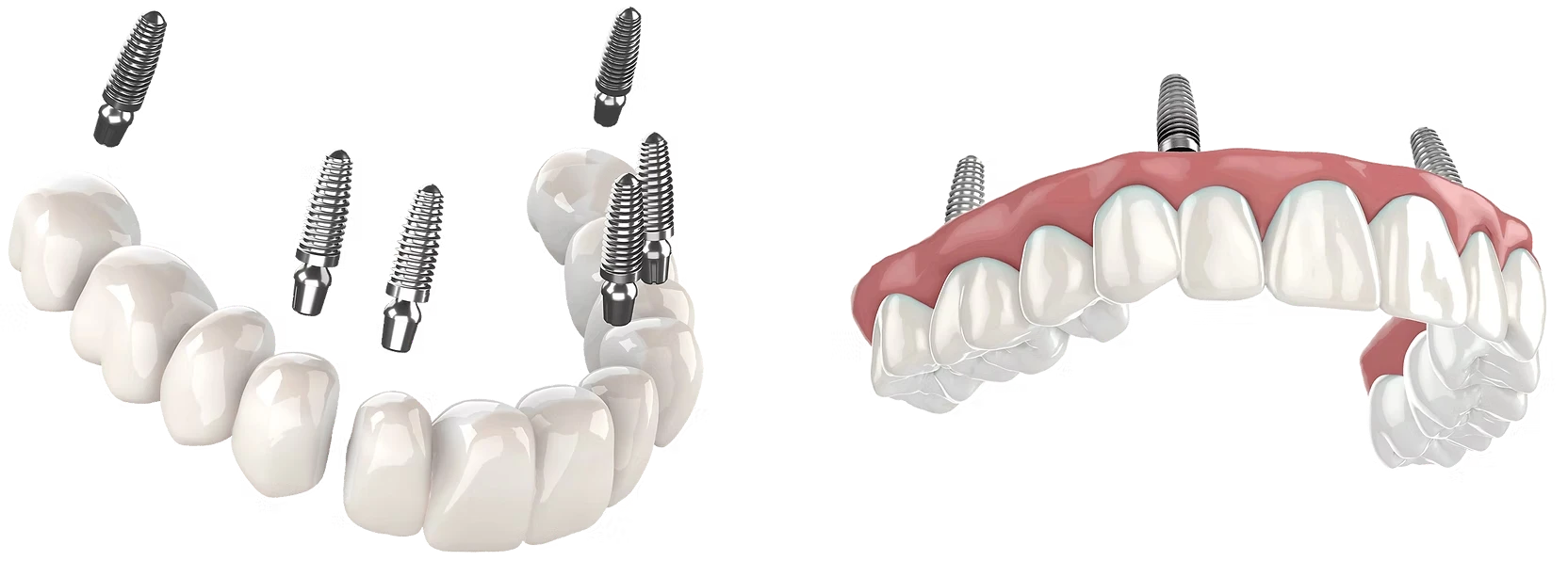Full arch dental implant restoration showing a complete fixed set of teeth at Destin Implant and Smile Studio in Destin, Florida