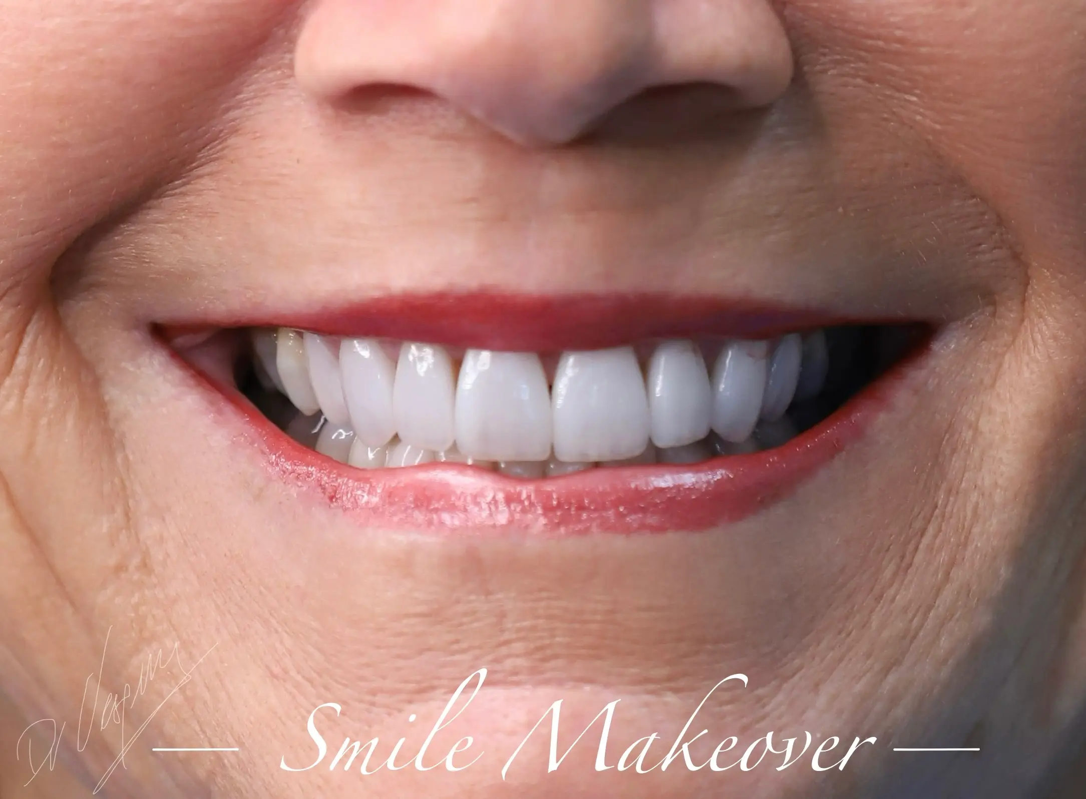 Patient smile after smile makeover treatment