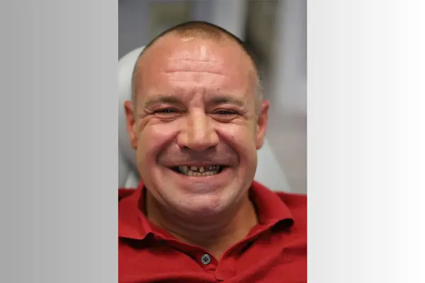 Patient smile before implant restoration
