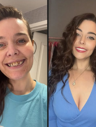 Patient before and after a full smile makeover