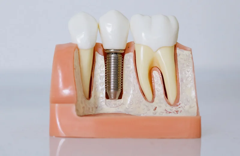 Single dental implant with a custom ceramic crown replacing one missing tooth