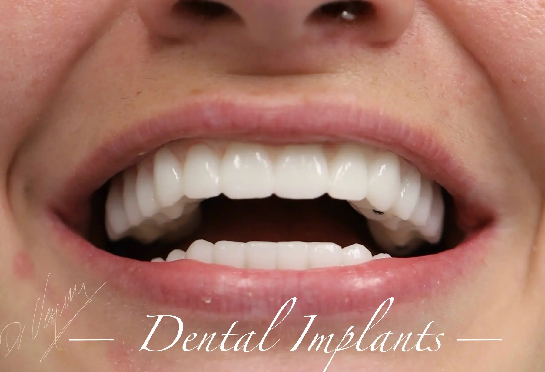 Patient smile after full arch implant treatment