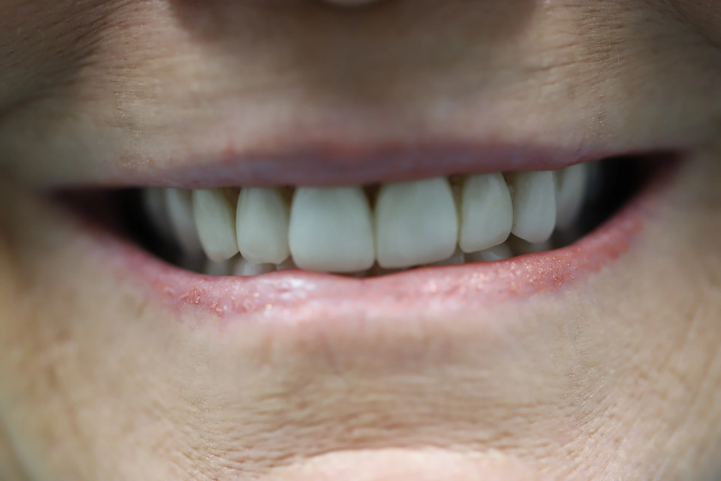 Patient smile before smile makeover treatment