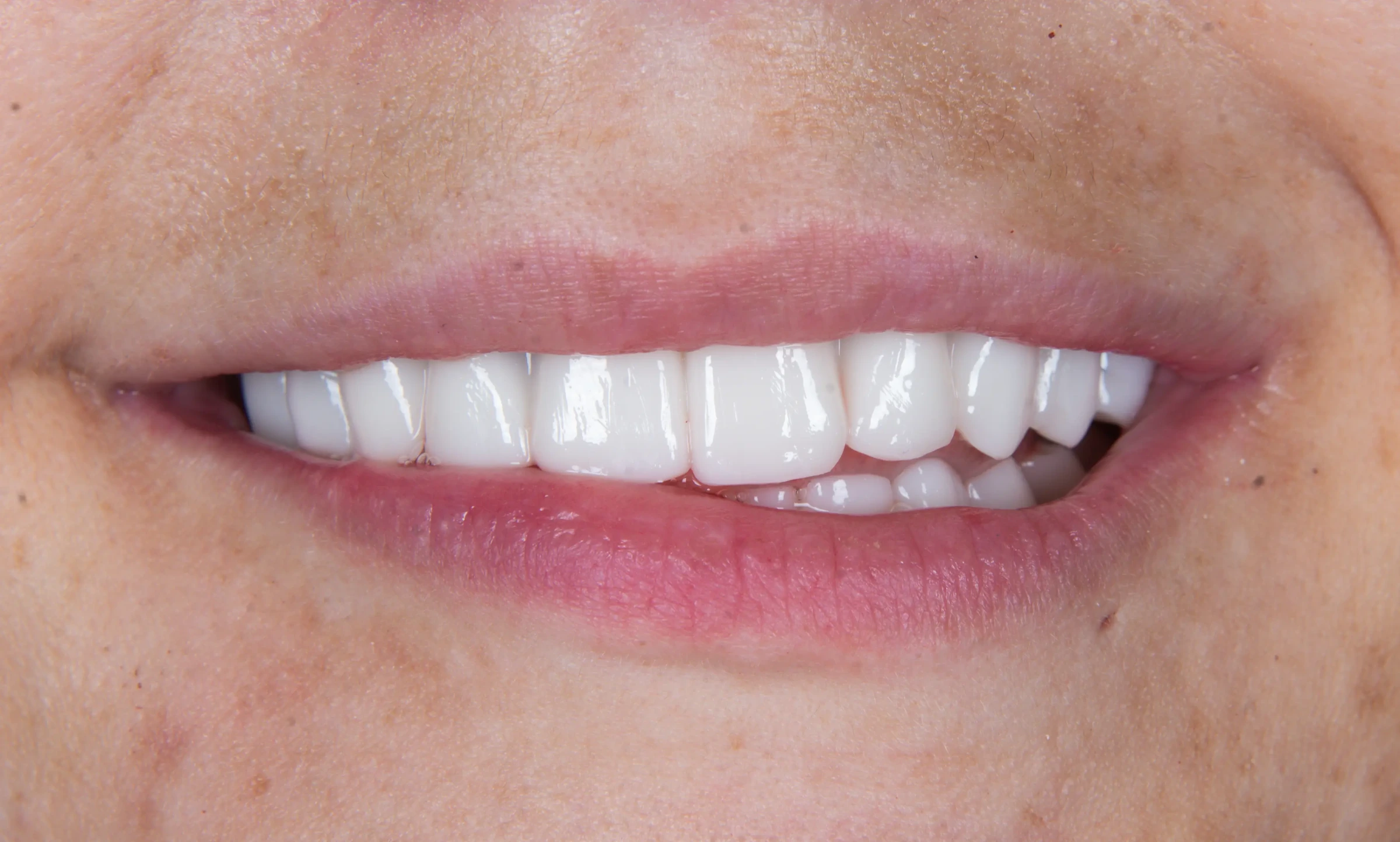 Patient smile after All-on-X implant treatment