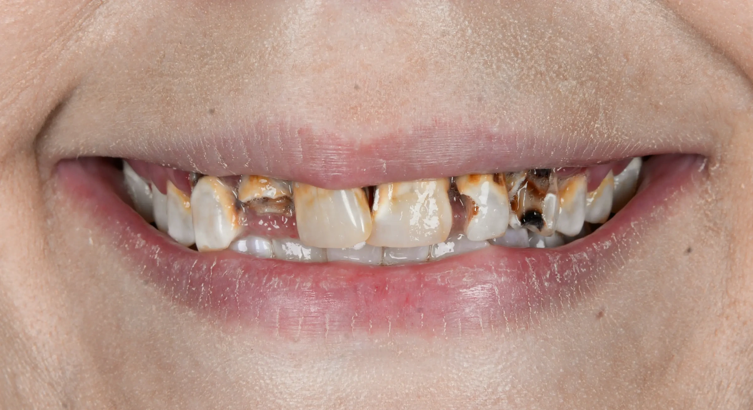 Patient smile before All-on-X implant treatment